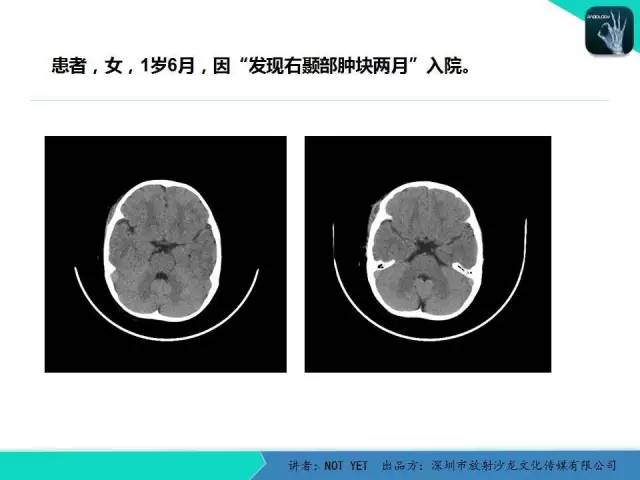 【病例】右侧颞上窝表皮样囊肿1例CT及MR