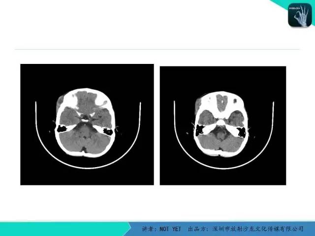 【病例】右侧颞上窝表皮样囊肿1例CT及MR
