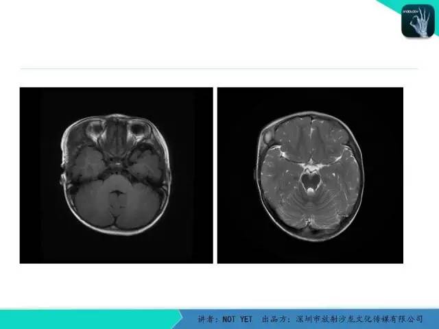 【病例】右侧颞上窝表皮样囊肿1例CT及MR
