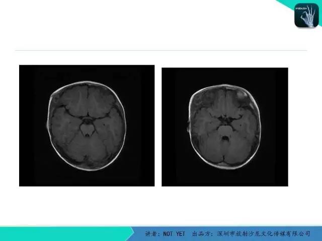 【病例】右侧颞上窝表皮样囊肿1例CT及MR