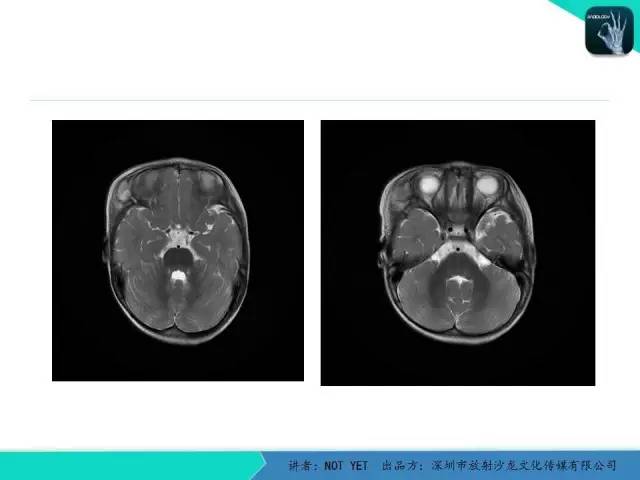【病例】右侧颞上窝表皮样囊肿1例CT及MR