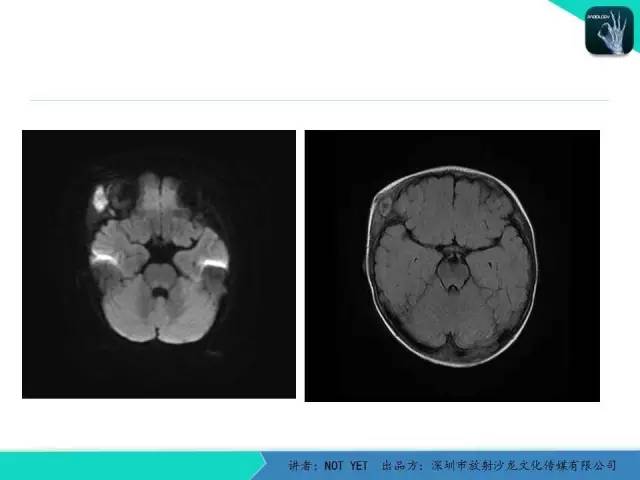 【病例】右侧颞上窝表皮样囊肿1例CT及MR