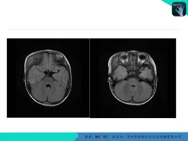 【病例】右侧颞上窝表皮样囊肿1例CT及MR