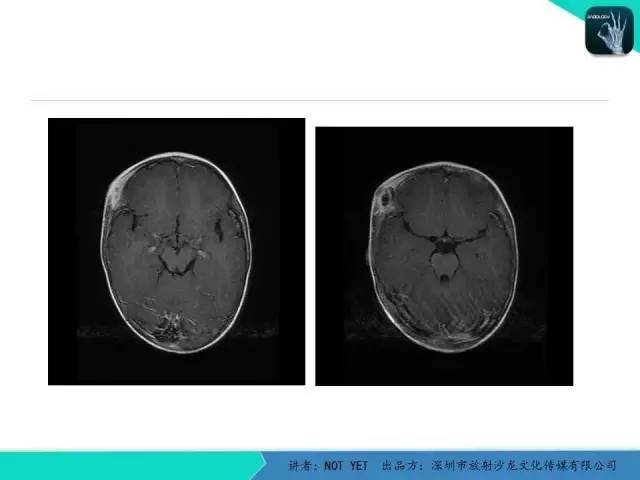 【病例】右侧颞上窝表皮样囊肿1例CT及MR