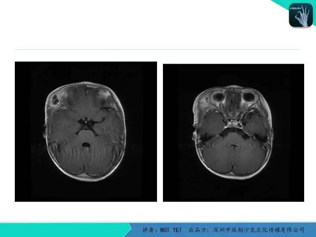 【病例】右侧颞上窝表皮样囊肿1例CT及MR