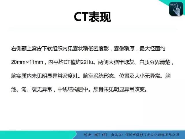 【病例】右侧颞上窝表皮样囊肿1例CT及MR