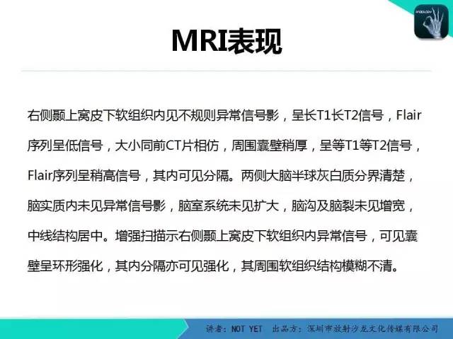 【病例】右侧颞上窝表皮样囊肿1例CT及MR