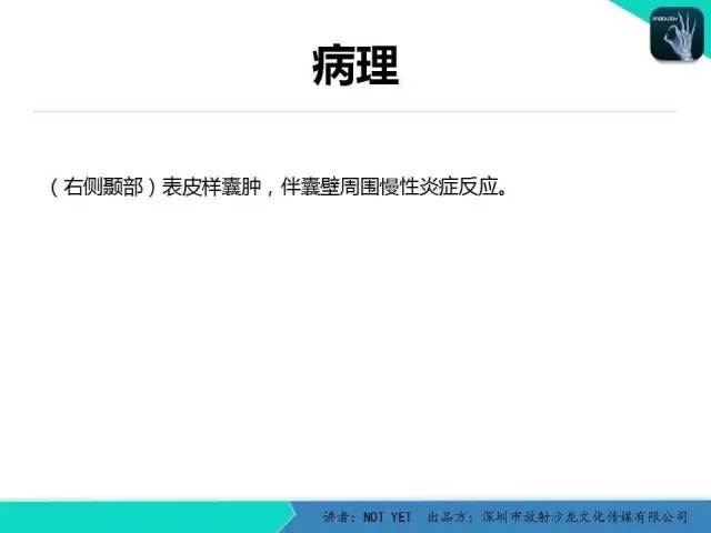【病例】右侧颞上窝表皮样囊肿1例CT及MR