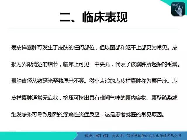 【病例】右侧颞上窝表皮样囊肿1例CT及MR