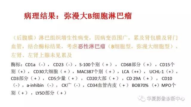 【病例】腹膜后恶性淋巴瘤1例CT影像表现