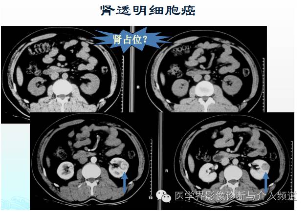 破谣言,破迷信,增强CT的5大问题不得不知! 破谣言,破迷信,增强CT的5大问题不得不知!