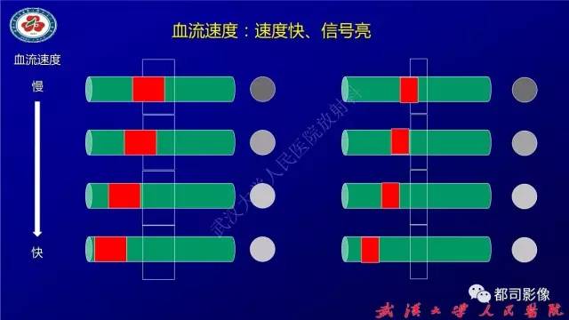 【PPT】高分辨率MRI在颈动脉粥样硬化斑块中的临床应用