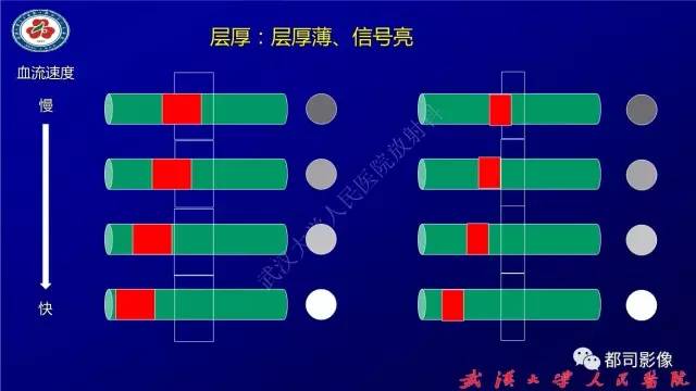 【PPT】高分辨率MRI在颈动脉粥样硬化斑块中的临床应用