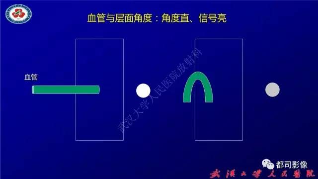 【PPT】高分辨率MRI在颈动脉粥样硬化斑块中的临床应用