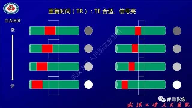 【PPT】高分辨率MRI在颈动脉粥样硬化斑块中的临床应用