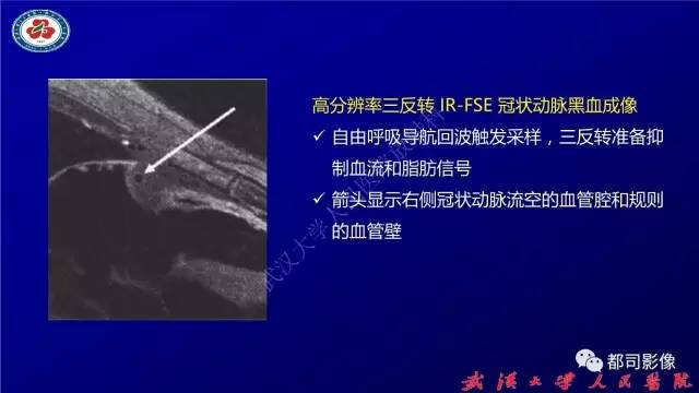 【PPT】高分辨率MRI在颈动脉粥样硬化斑块中的临床应用