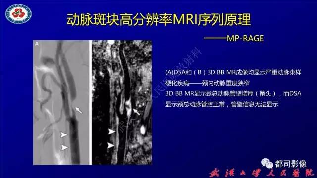【PPT】高分辨率MRI在颈动脉粥样硬化斑块中的临床应用