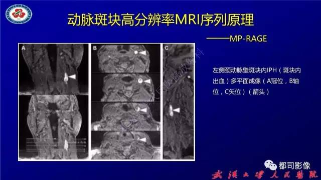 【PPT】高分辨率MRI在颈动脉粥样硬化斑块中的临床应用