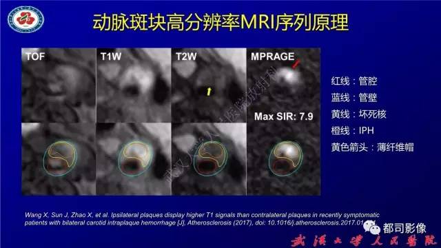 【PPT】高分辨率MRI在颈动脉粥样硬化斑块中的临床应用