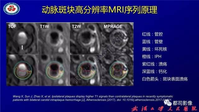【PPT】高分辨率MRI在颈动脉粥样硬化斑块中的临床应用