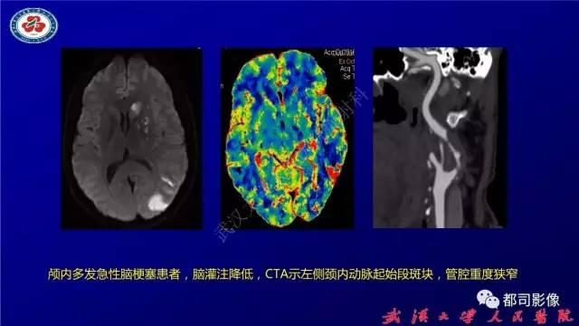 【PPT】高分辨率MRI在颈动脉粥样硬化斑块中的临床应用