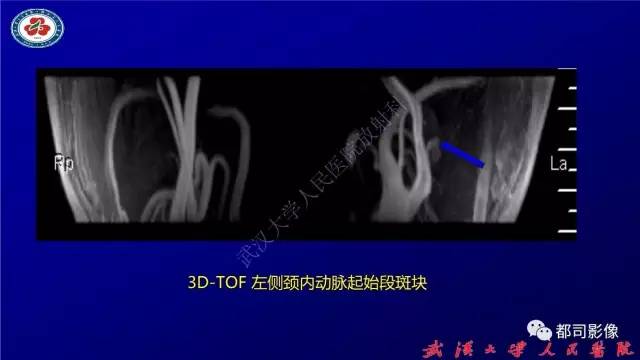 【PPT】高分辨率MRI在颈动脉粥样硬化斑块中的临床应用