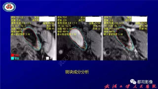 【PPT】高分辨率MRI在颈动脉粥样硬化斑块中的临床应用