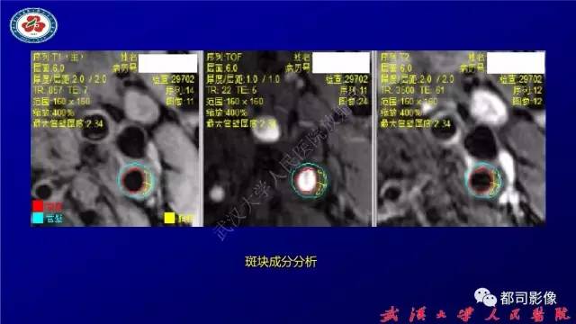 【PPT】高分辨率MRI在颈动脉粥样硬化斑块中的临床应用