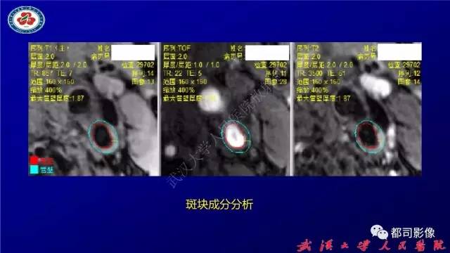 【PPT】高分辨率MRI在颈动脉粥样硬化斑块中的临床应用