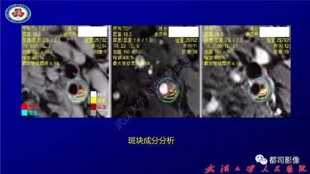 【PPT】高分辨率MRI在颈动脉粥样硬化斑块中的临床应用