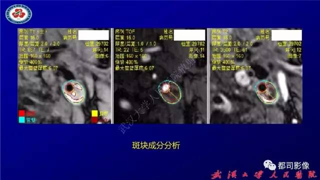 【PPT】高分辨率MRI在颈动脉粥样硬化斑块中的临床应用