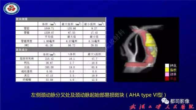 【PPT】高分辨率MRI在颈动脉粥样硬化斑块中的临床应用