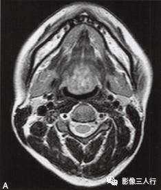 【病例】舌根异位甲状腺1例MR影像表现分析