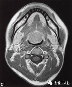 【病例】舌根异位甲状腺1例MR影像表现分析