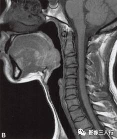 【病例】舌根异位甲状腺1例MR影像表现分析