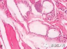 【病例】舌根异位甲状腺1例MR影像表现分析