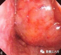 【病例】舌根异位甲状腺1例MR影像表现分析
