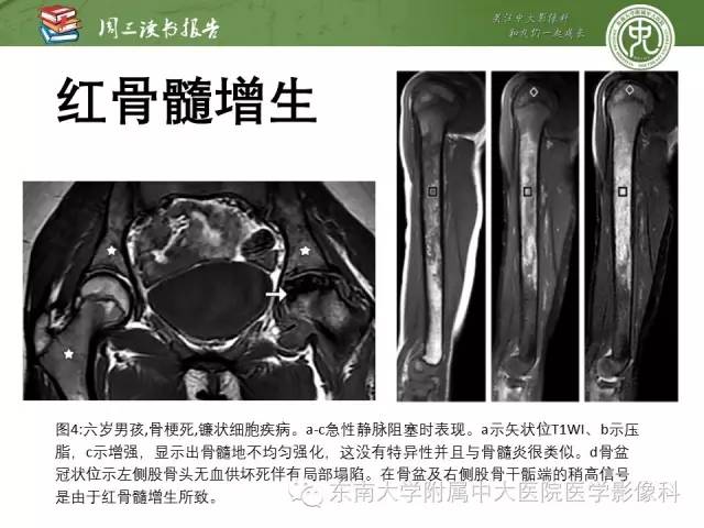 【PPT】儿童骨髓MRI表现