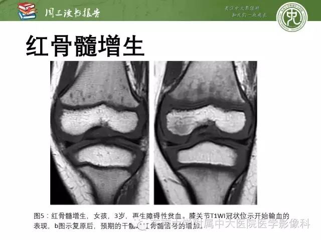 【PPT】儿童骨髓MRI表现