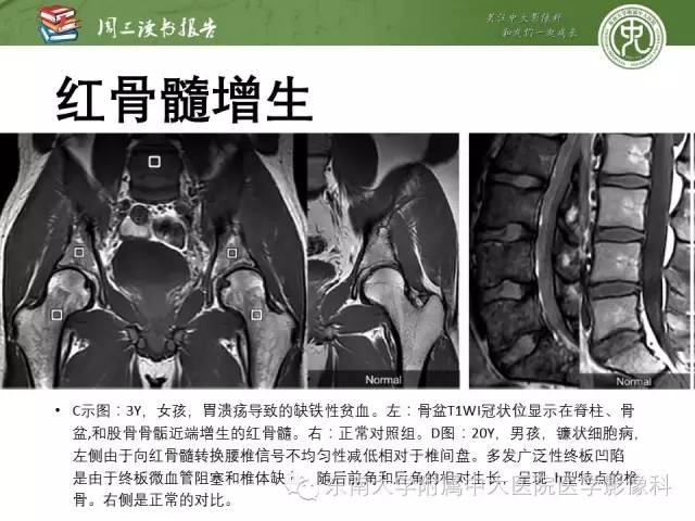 【PPT】儿童骨髓MRI表现