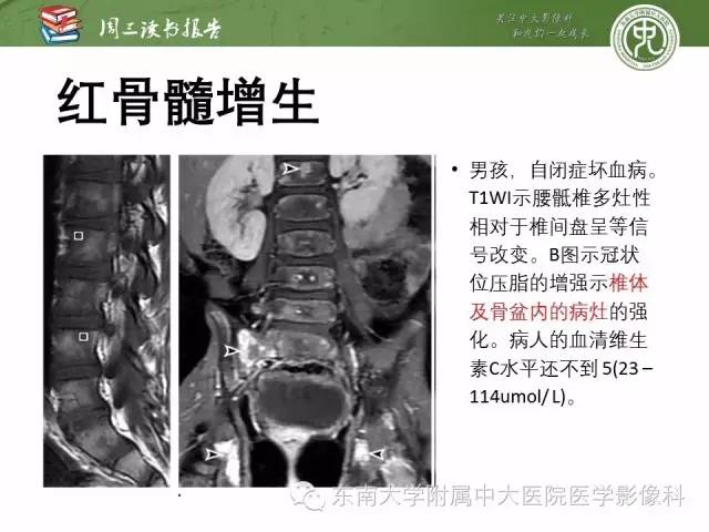 【PPT】儿童骨髓MRI表现