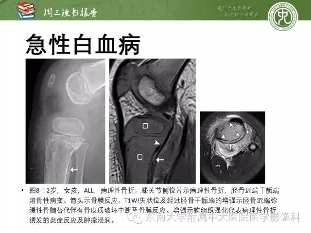 【PPT】儿童骨髓MRI表现