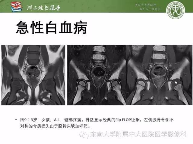 【PPT】儿童骨髓MRI表现