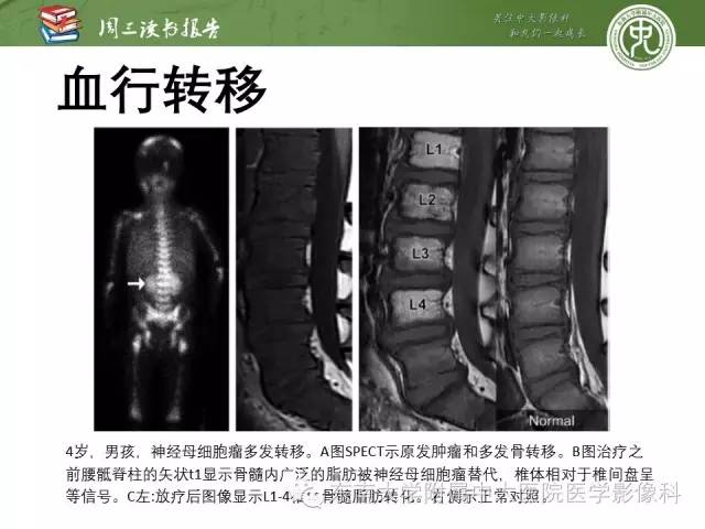 【PPT】儿童骨髓MRI表现