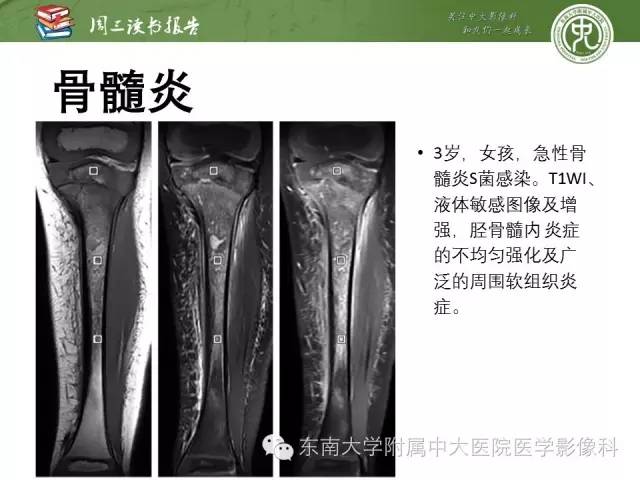 【PPT】儿童骨髓MRI表现