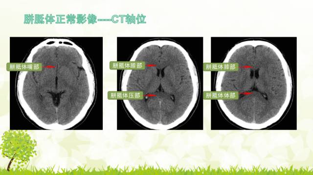 【PPT】胼胝体影像学