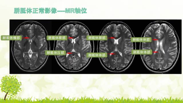 【PPT】胼胝体影像学