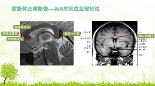 【PPT】胼胝体影像学