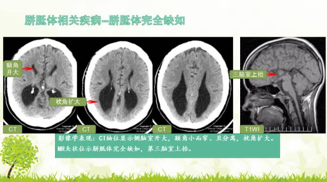 【PPT】胼胝体影像学