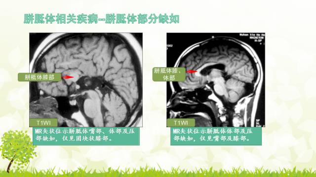 【PPT】胼胝体影像学
